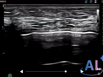 Reconnaissance automatique des muscles et de la graisse 