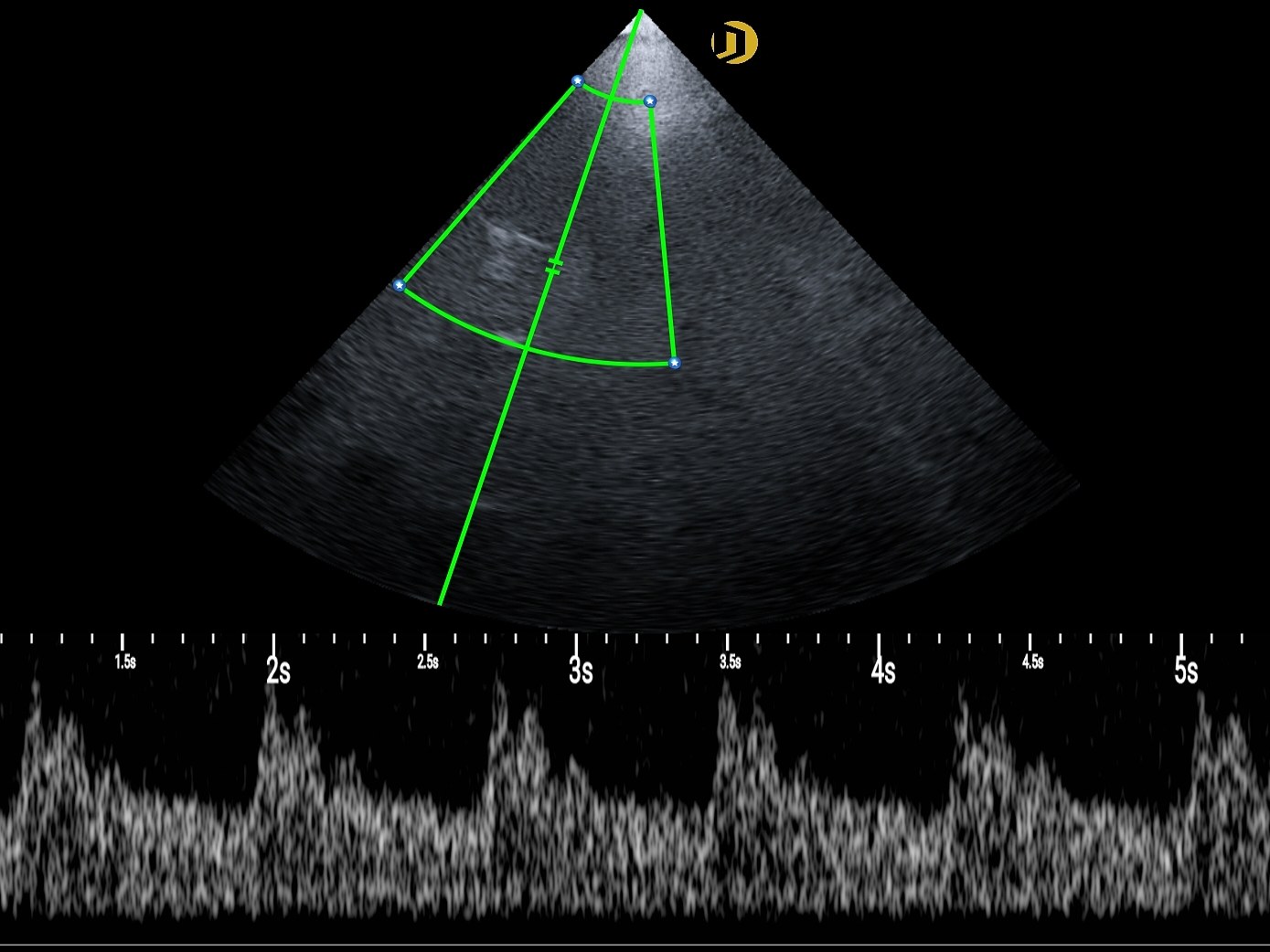 Réseau multiéléments, Doppler transcrânien
