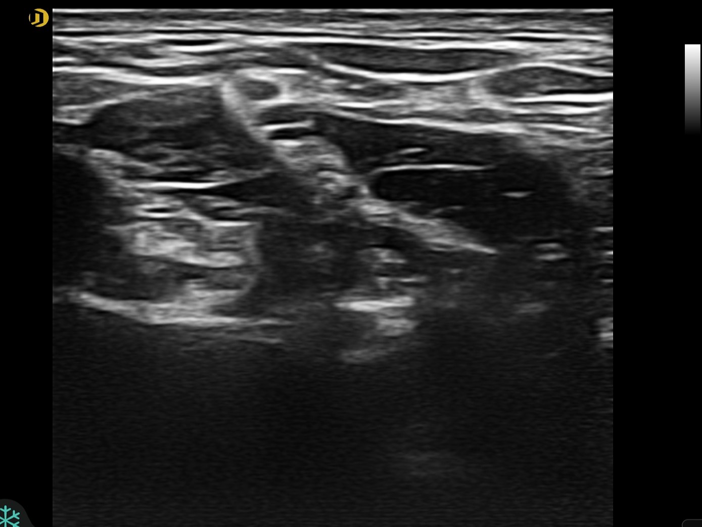 Plexus brachial linéaire