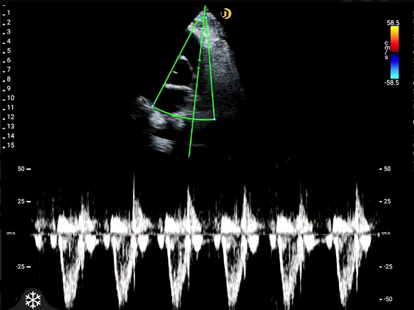 Réseau multiéléments, cardiaque, PW