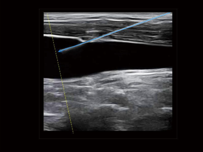 Amélioration de la crevaison