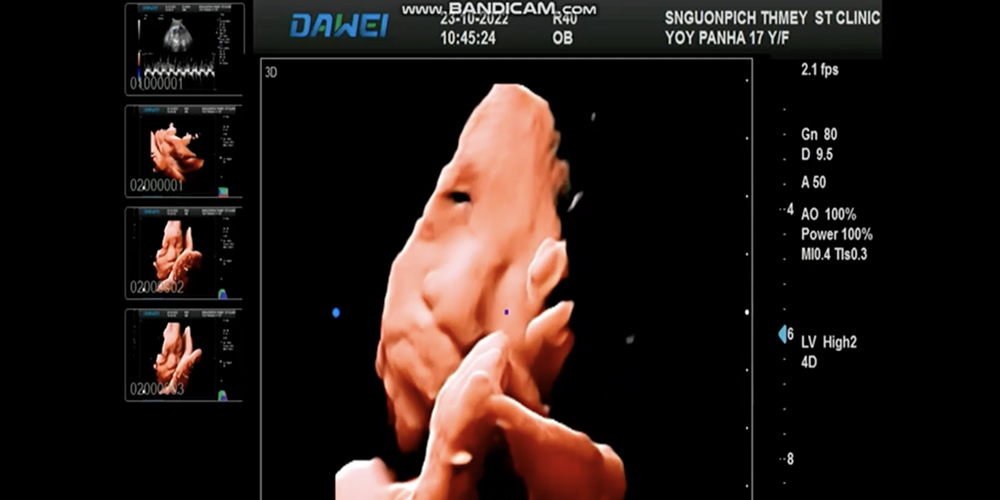 Imazhe 4D e v&euml;rtet&euml; e l&euml;kur&euml;s s&euml; fetusit 