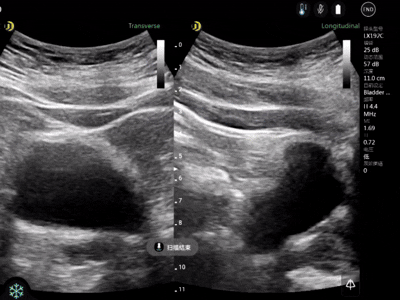mesure automatique du volume de la vessie 