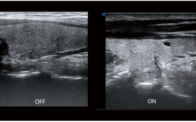 تصوير الحد من البقع