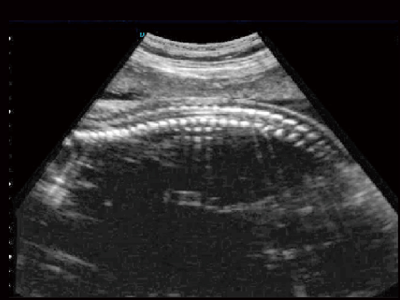 Examen de la colonne vertébrale fœtale