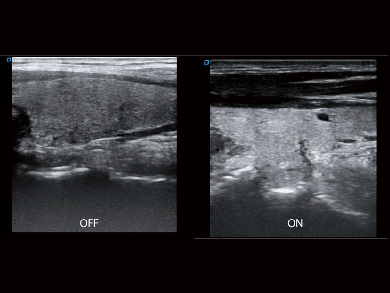 Technique de suppression du bruit speckle