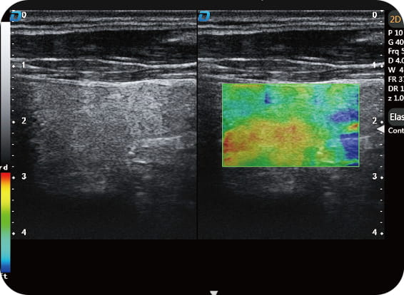 elastography 