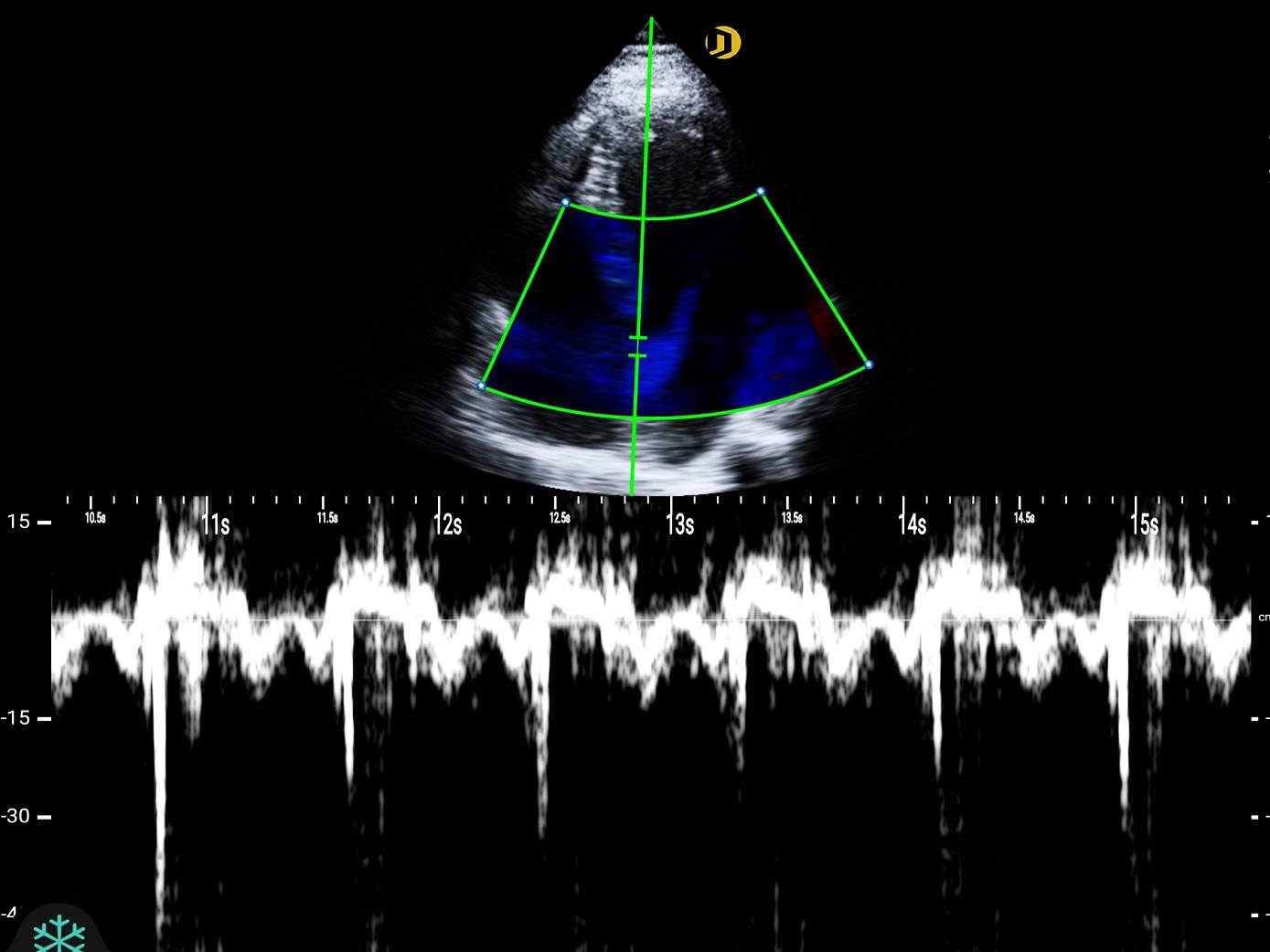 Réseau multiéléments, cardiaque, TDI
