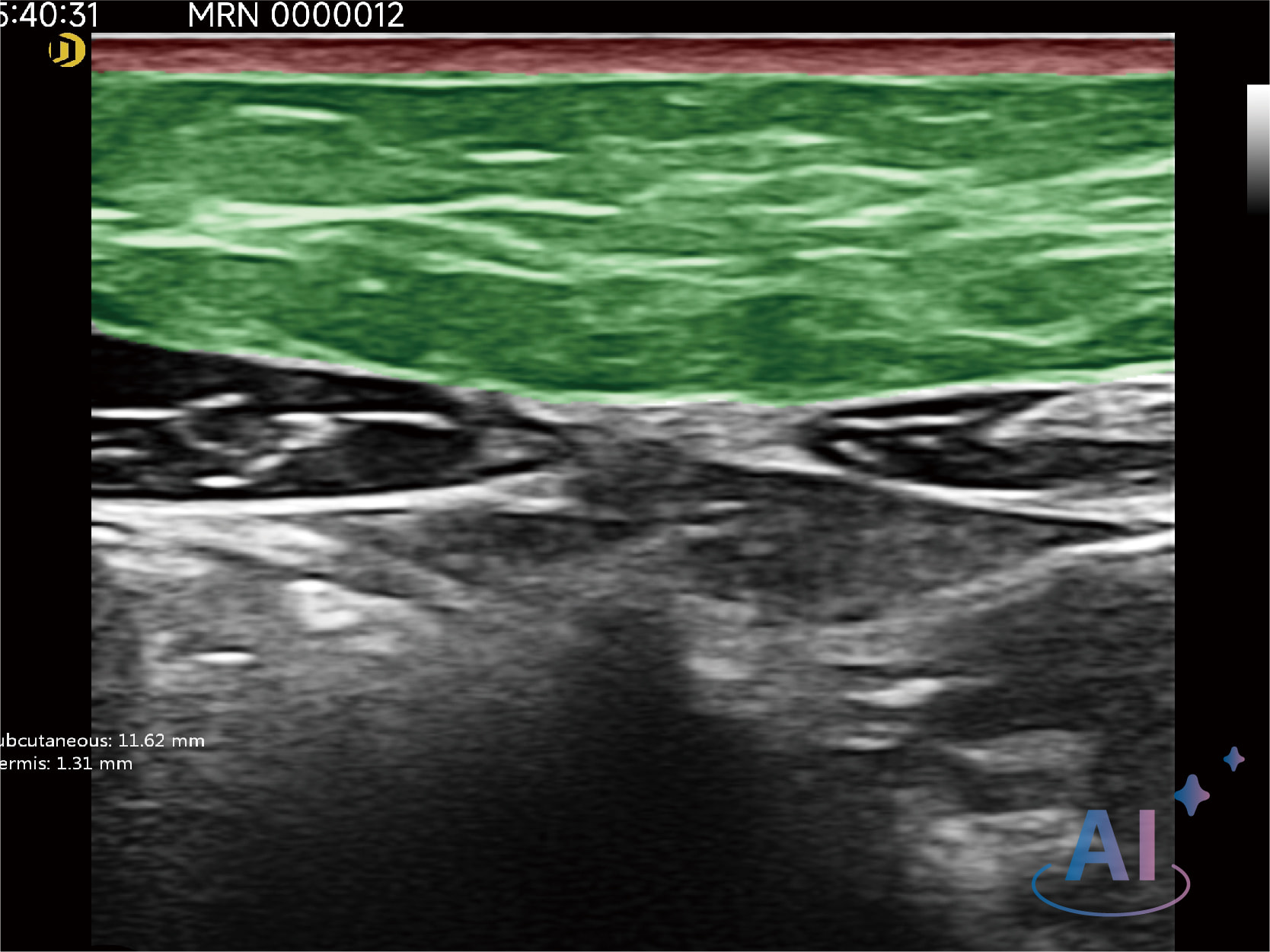 An&aacute;lisis de grasa abdominal 